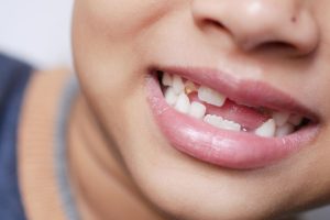 permanent teeth growing behind baby teeth