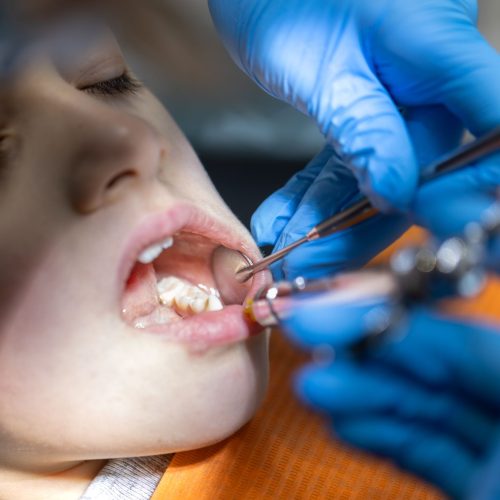 Why Does My Toddler Have Cavities Already? Causes & What Parents in Parkland Should Do
